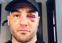 Eddie Alvarez suýt bị 'xé' mất mí mắt tại A New Era