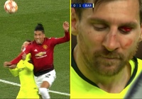 Tin bóng đá 13/4: HLV Valverde hé lộ tình hình Messi sau va chạm kinh hoàng