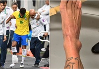 Neymar tung ảnh mắt cá chân sưng to... "kinh dị" sau khi bị loại khỏi Copa America 2019