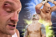 NÓNG: Tyson Fury rách mắt, dời lịch trận so găng Oleksandr Usyk