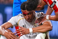 Mbappe đổ máu sau pha phạm lỗi dẫn đến quả phạt đền không được thổi phạt