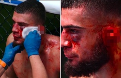 Chấn thương rách tai rợn người của võ sĩ UFC sau loạt chỏ từ đối thủ