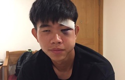 Va chạm mạnh, khuôn mặt của cựu cầu thủ HAGL bị “biến dạng” 