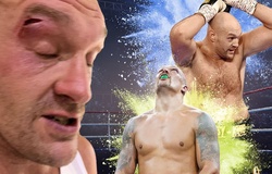 NÓNG: Tyson Fury rách mắt, dời lịch trận so găng Oleksandr Usyk