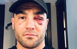 Eddie Alvarez suýt bị 'xé' mất mí mắt tại A New Era