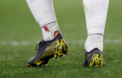 Hazard bị đối thủ phạm lỗi đến mức chảy máu và rách cả bít tất