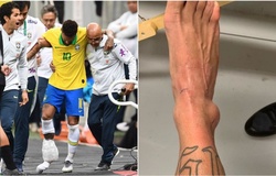 Neymar tung ảnh mắt cá chân sưng to... "kinh dị" sau khi bị loại khỏi Copa America 2019