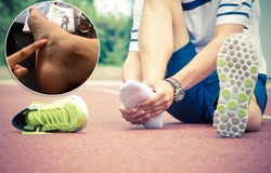 Bệnh viêm cân gan chân khi chạy: Nỗi lo và cách khắc phục