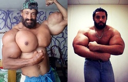 Những lực sĩ thể hình lạm dụng tiêm hóa chất khiến cơ bắp thành thảm họa