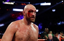 Tyson Fury khâu 50 mũi sau trận đấu với Otto Wallin