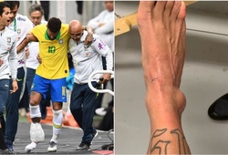 Neymar tung ảnh mắt cá chân sưng to... "kinh dị" sau khi bị loại khỏi Copa America 2019