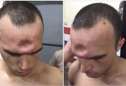 Bản tin MMA 15/12: Võ sĩ Muay Thái dính chỏ, móp xương trán
