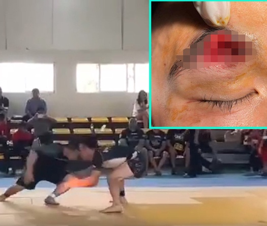 Tai nạn húc đầu tại giải Jujitsu toàn quốc, võ sĩ phải khâu 30 mũi