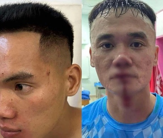 Đánh nhau gây đổ máu, Xuân Nam và Vũ Văn Sơn nhận án phạt thích đáng