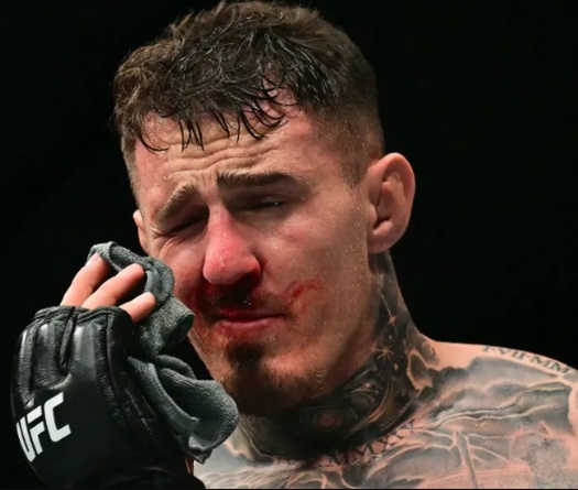 Tom Aspinall phải phẫu thuật hai mắt sau sự cố chọc mắt tại UFC 321