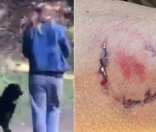 Chạy bộ gặp chó bị... chủ chó cắn ngập răng