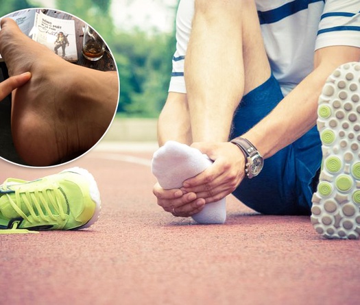 Bệnh viêm cân gan chân khi chạy: Nỗi lo và cách khắc phục
