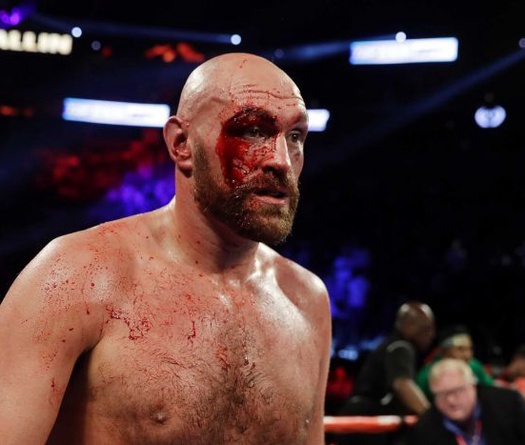 Tyson Fury khâu 50 mũi sau trận đấu với Otto Wallin