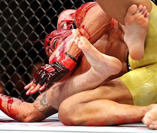 Alex Oliveira khâu 29 mũi trên đầu sau khi "ăn" cùi chỏ của Gunnar Nelson