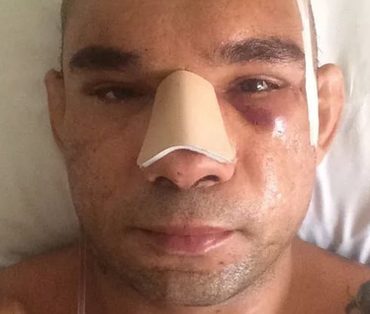 'Cyborg' Santos phẫu thuật thành công