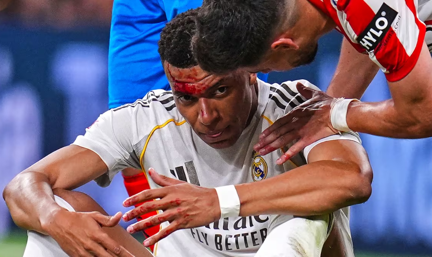 Mbappe đổ m&aacute;u sau pha phạm lỗi dẫn đến quả phạt đền kh&ocirc;ng được thổi phạt