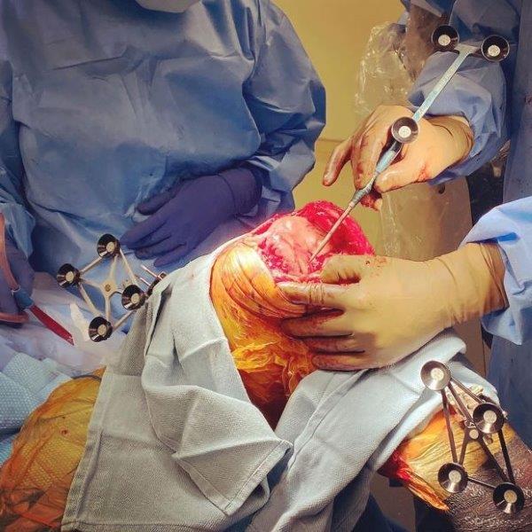 Huyền thoại UFC Michael Bisping chia sẻ hình ảnh phẫu thuật ghép đầu gối