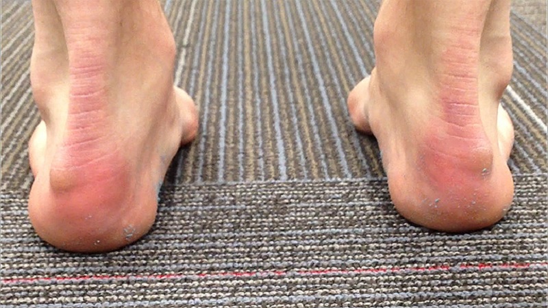 Chấn thương khi chạy bộ. Phần 4: Đau gót chân