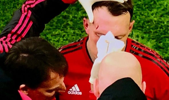 Cận cảnh chấn thương rợn người của Phil Jones ở trận gặp West Ham