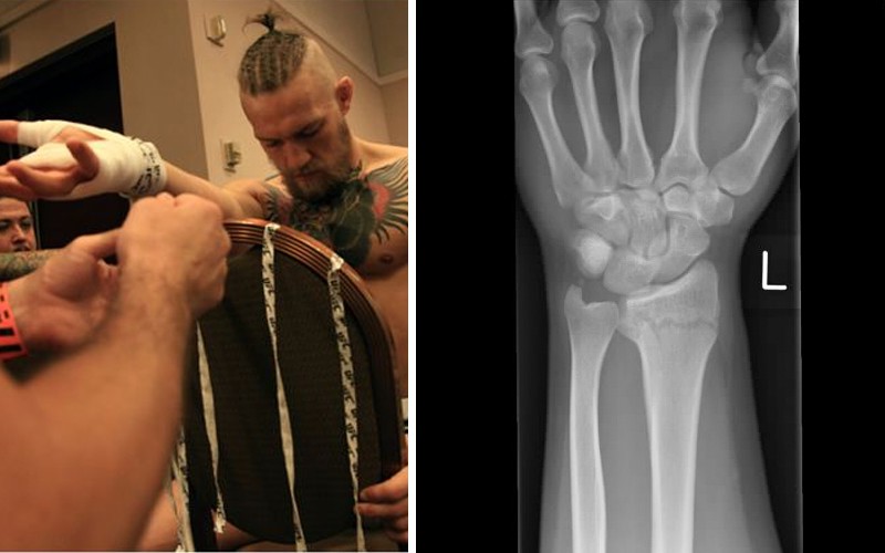 Những chấn thương nứt xương trong MMA - Boxing và cách phòng tránh - Ảnh 1.