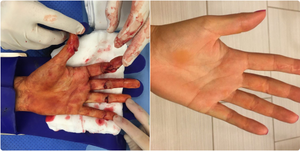Bàn tay của Kvitova trước và sau khi hồi phục