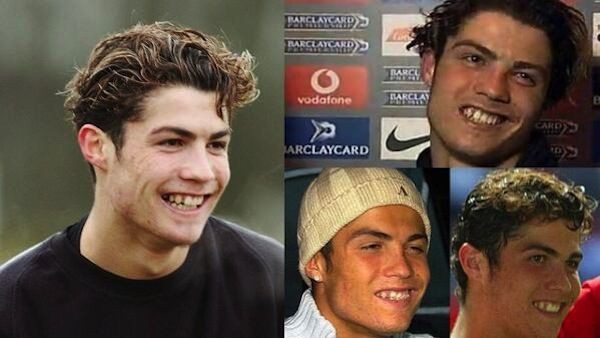 Ronaldo từng thẩm mỹ răng