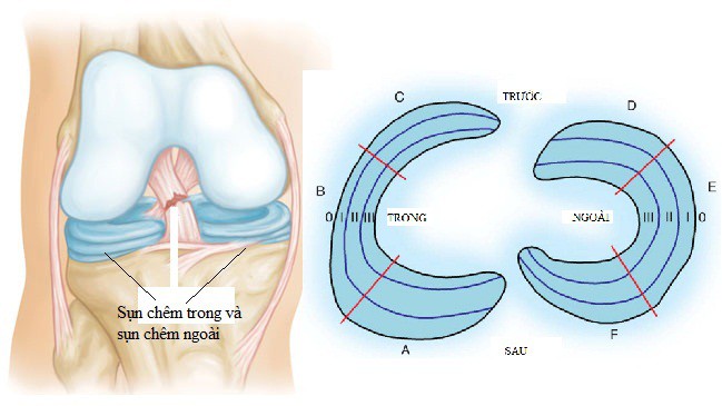 Giải phẫu sụn chêm: A. sừng sau, B. thân, C. sừng trước; I. vùng giàu mạch, II. vùng nghèo mạch, III. vùng vô mạch