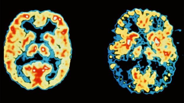 Nghiên cứu khoa học cho thấy việc mất trí nhớ có thể liên quan đến đánh đầu