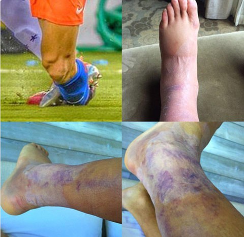 Hình ảnh chân trái tím tái của Sanchez được cập nhật cách đây vài giờ.