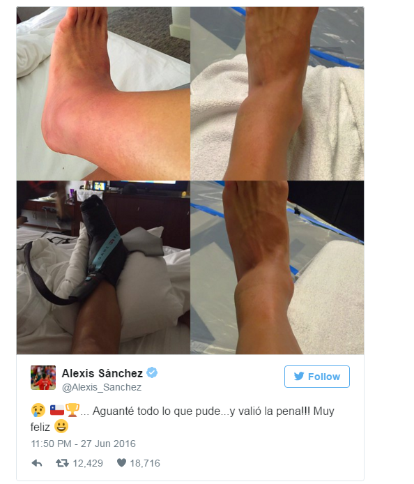 Hình ảnh chấn trái sưng đỏ của Sanchez trên mạng xã hội.