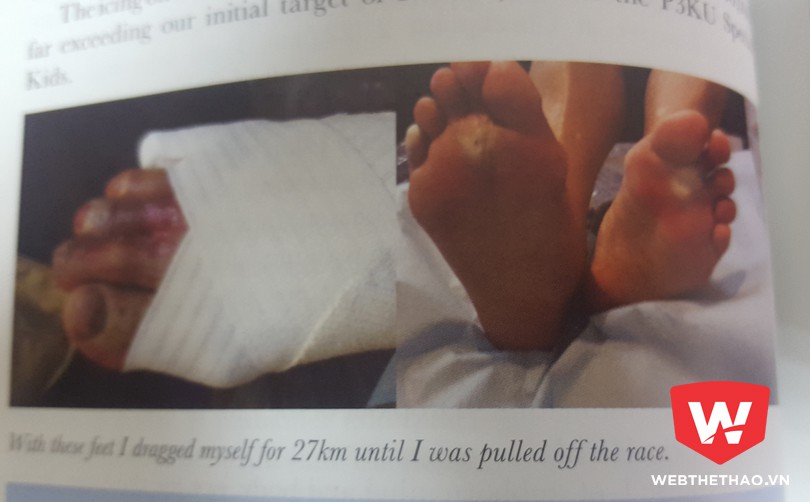 Đôi bàn chân bị phồng giộp của cụ Yee tại Marathon des sables. 
