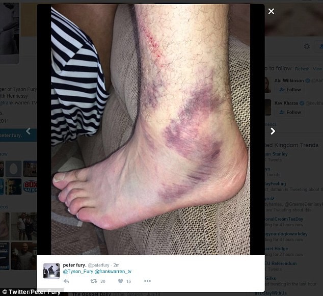 Hình ảnh về chấn thương của Tyson Fury được ông Peter đăng tải trên mạng xã hội.