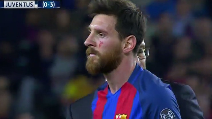 Máu đã chảy trên khuôn mặt Lionel Messi sau pha tiếp đất cực kỳ nguy hiểm trong hiệp 1.